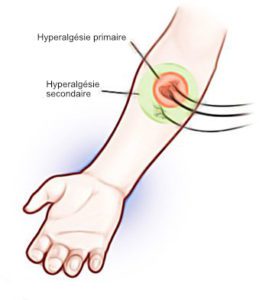 Hyperalgésie primaire et secondaire
